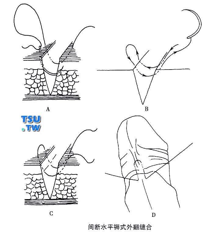 包皮手术创口间断水平褥是外翻缝合
