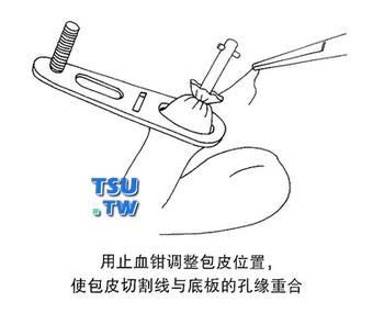 用止血钳调整包皮位置，使包皮切割线与底板的孔缘重合