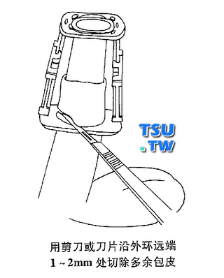 用剪刀或刀片沿外环远端1-2mm处切除多余包皮