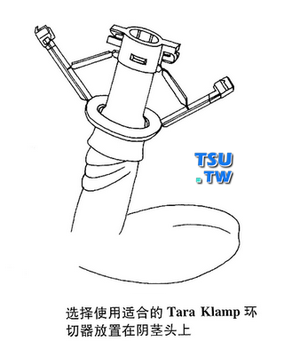 选择使用合适的Tara Klamp环切器放置在阴茎头上