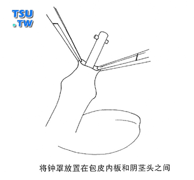 将钟罩放置在包皮内板和阴茎头之间