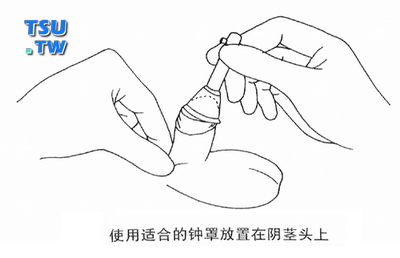 使用适合的钟罩放置在阴茎头上