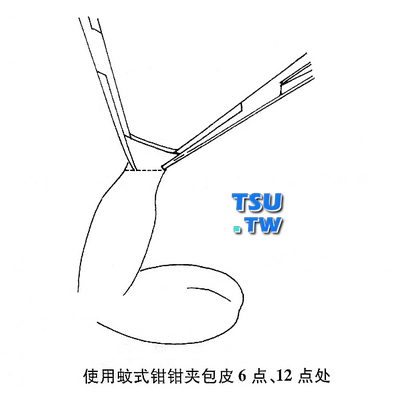 蚊式钳回翻包皮