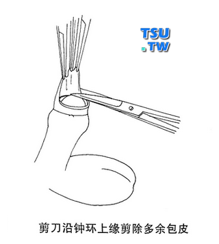 剪刀沿着钟环上缘剪去多于的包皮