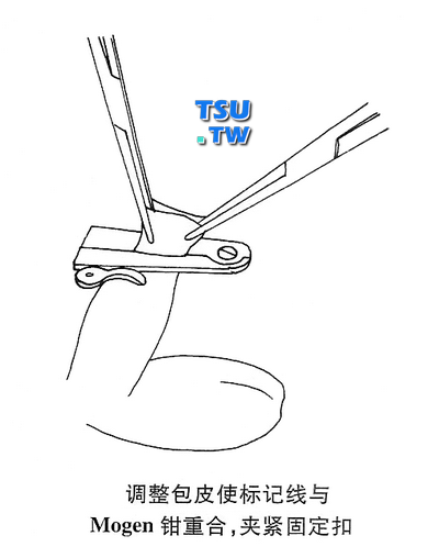 调整包皮并加紧