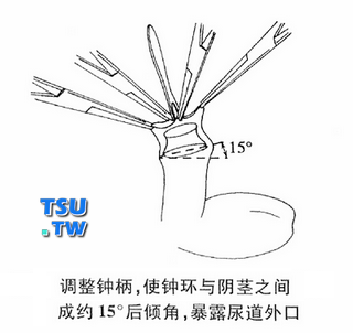 调整钟柄，使钟环与阴茎之间约成15°角