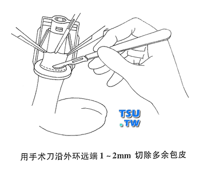 用手术刀沿外环远端1-2mm切除多于包皮