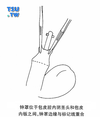 钟罩位于包皮腔内阴茎头和包皮内板之间，钟罩边缘与标记线重合