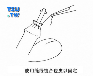 使用缝线缝合包皮以固定