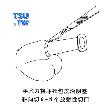 手术刀将坏死包皮沿阴茎 轴向切6-8个放射性切口