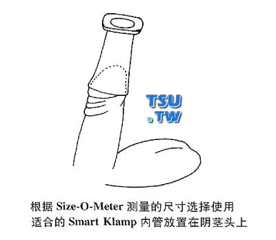 根据Size-O-Meter测量的尺寸选择使用 适合的Smart Klamp内管放置在阴茎头上