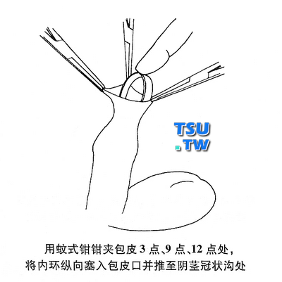 韩式环切器图解图片