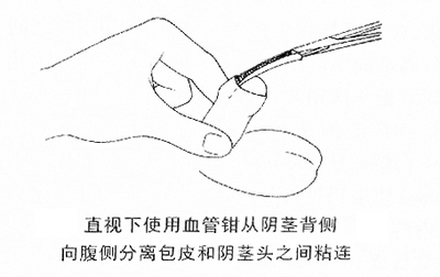 直视下使用血管钳从阴茎背侧向腹侧分离包皮和阴茎头之间粘连