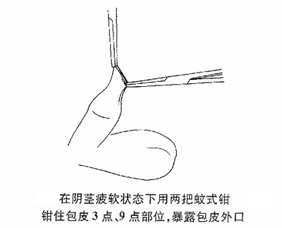 割包皮手术前医生的准备工作