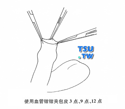 用血管钳夹住包皮