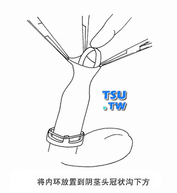 套入包皮内环