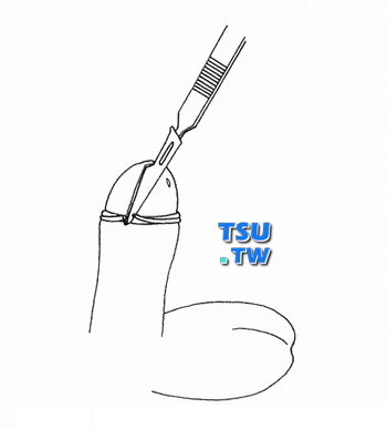 剪去坏死的包皮