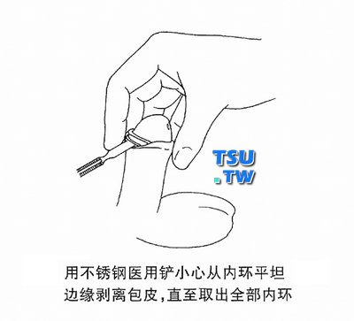 用不锈钢医用铲小心从内环平坦边缘剥离包皮，直至取出全部内环。