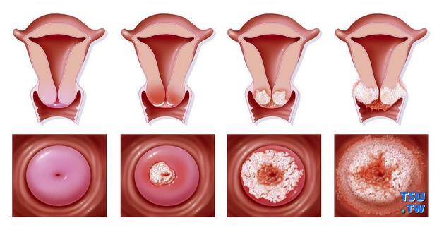 割包皮手术能有效减少人乳头瘤病毒（HPV）的性传播