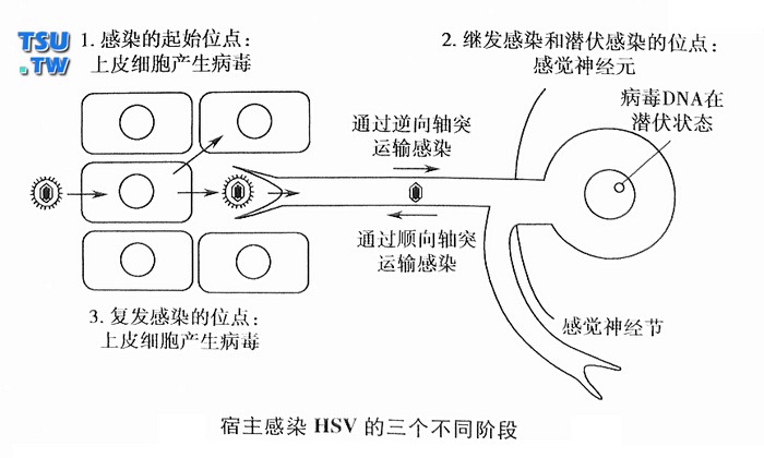 包皮手术能有效减少二型人单纯疱疹病毒的性传播