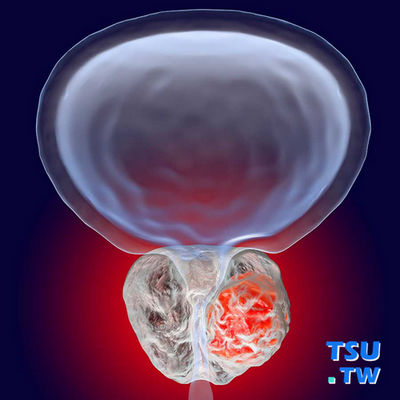 前列腺增生和前列腺肿瘤有什么关系？