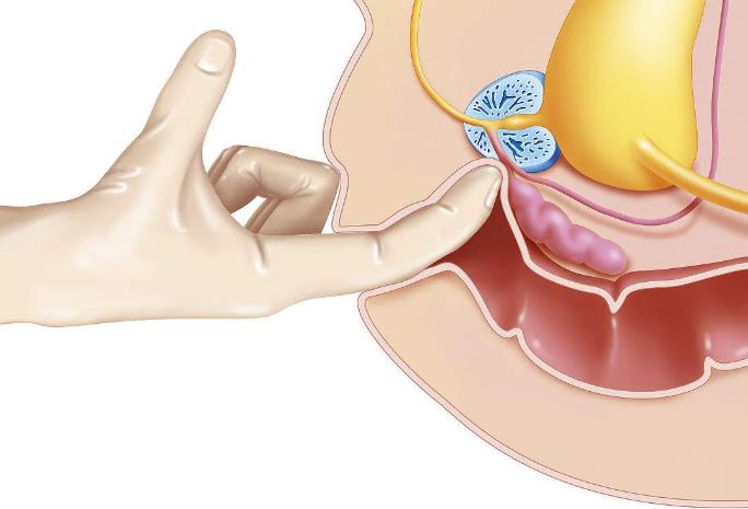 前列腺增生直肠指检