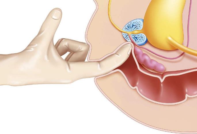指检前列腺感觉要弯了图片
