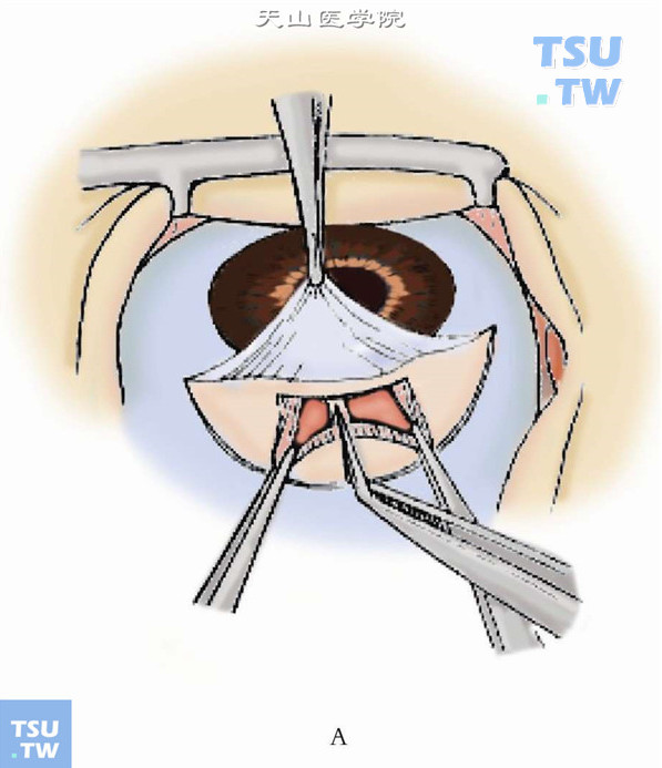 用虹膜剪将脱出的虹膜在切口中央做与角膜缘垂直的剪开，从12点的瞳孔缘直到虹膜根部，使虹膜均匀地分为两部分