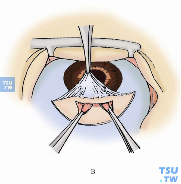 再用两把显微镊分别夹住两侧的虹膜基底部，轻轻向外侧扯开，分别将虹膜组织嵌在切口两端，中间有约2～3mm宽的缝隙。房水缓缓渗出，瞳孔呈U字形