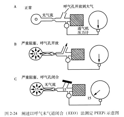 闸述以呼气末气道闭合( EEO)法测定PEEPi示意图