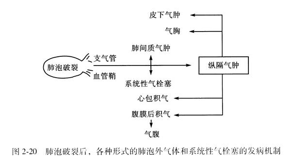 肺泡破裂后，各种形式的肺泡外气体和系统性气栓塞的发病机制