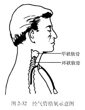 经气管给氧示意冈