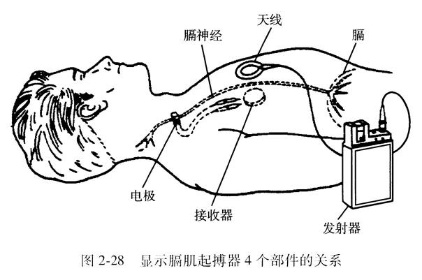 体内膈肌起搏器由哪几部分组成？