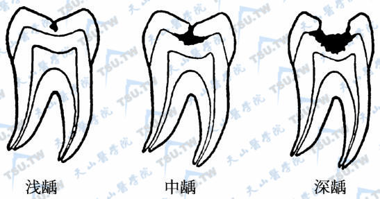 龋病按病变程度分类