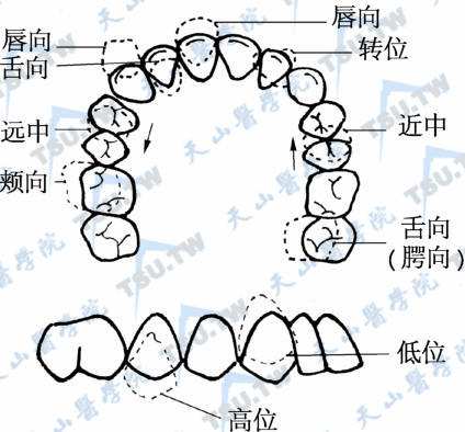 个别牙齿错位