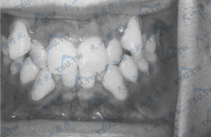 牙列拥挤