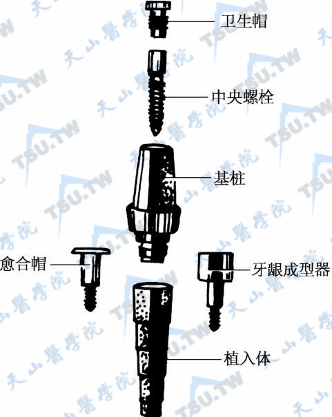 种植义齿的基本组成