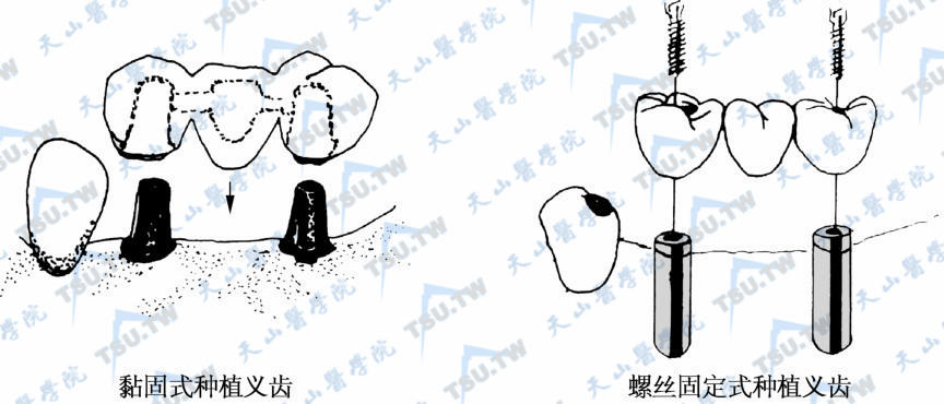 固定式种植义齿