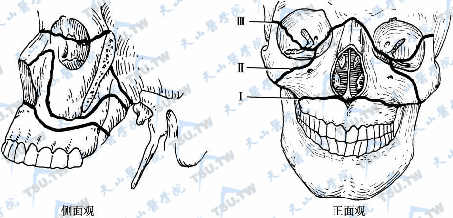 上颌骨横断骨折的3种类型（Le Fort分型）