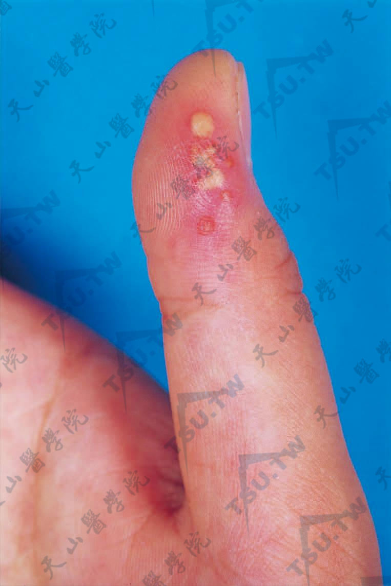 疱疹性瘭疽　指尖部群集水疱，融合成蜂窝状，周围红晕明显