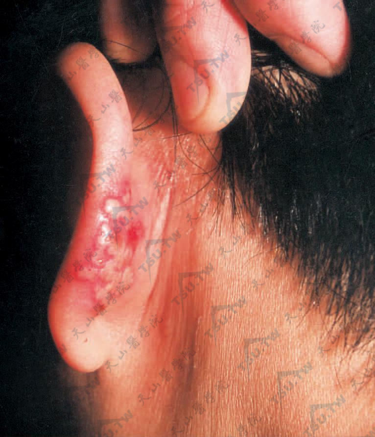 左耳壳后群集水疱，周围有红晕，部分水疱融合成多房状