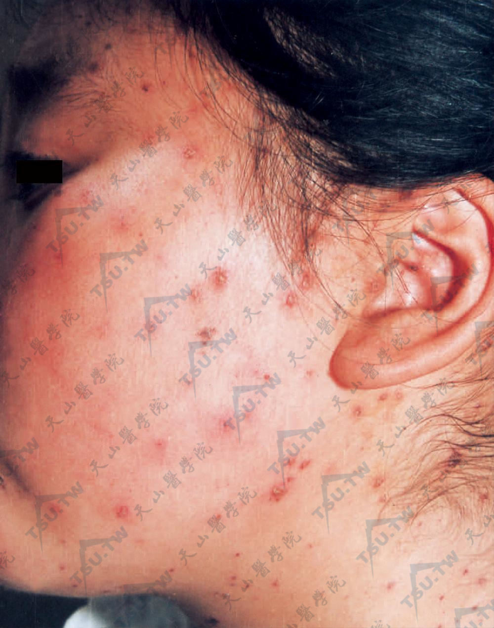 皮疹广泛，已扩展至面部