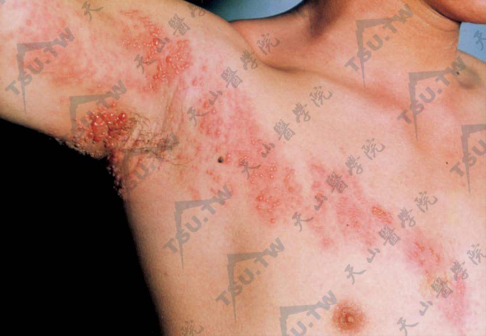 右胸、腋及上臂部出现多数不规则红斑，红斑上群集有粟粒至绿豆大的水疱或丘疹，呈带状分布，发生在身体一侧，不超过中线
