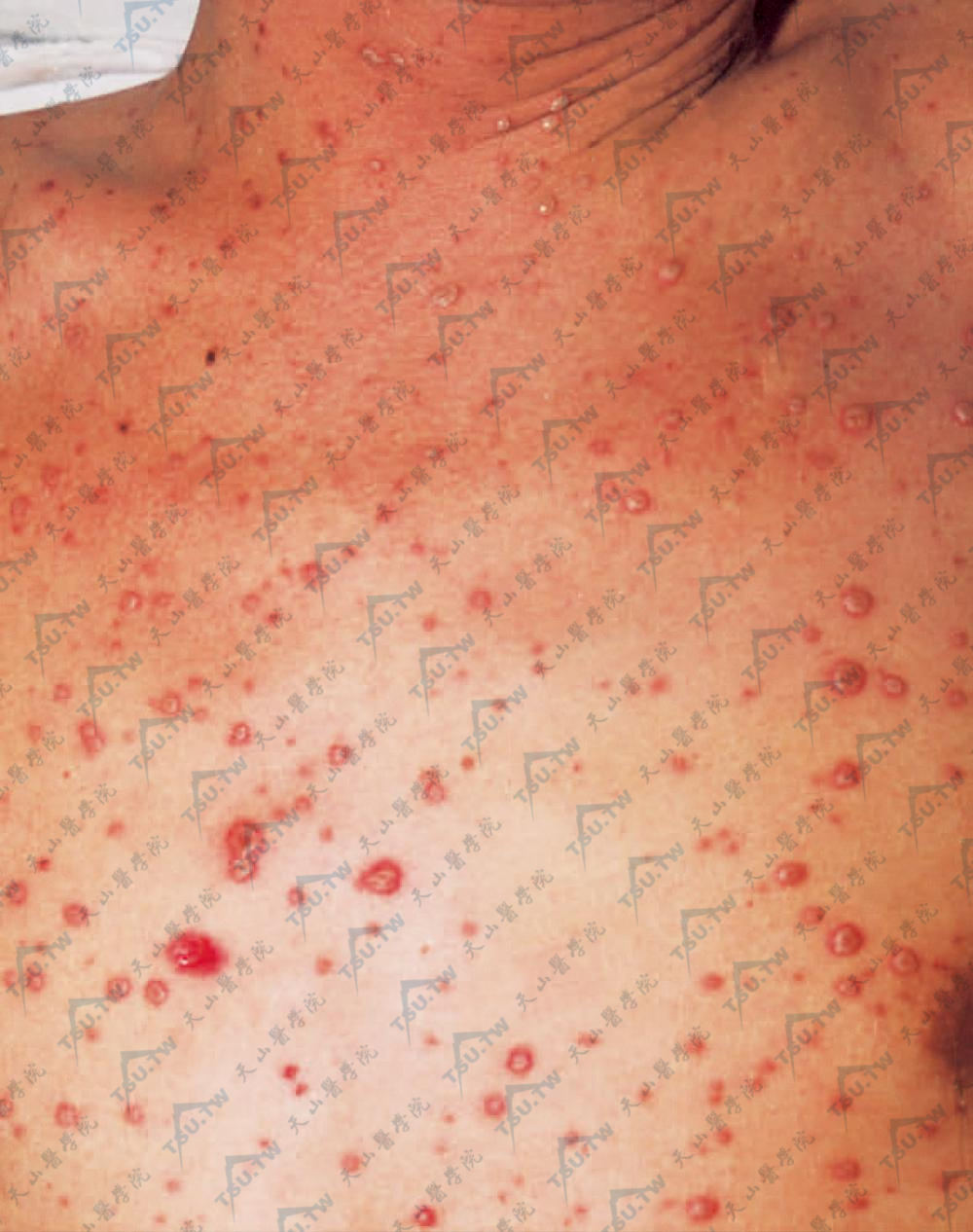 播散性带状疱疹。除群集水疱外，全身泛发绿豆大小水疱，周围有红晕，类似水痘样发疹