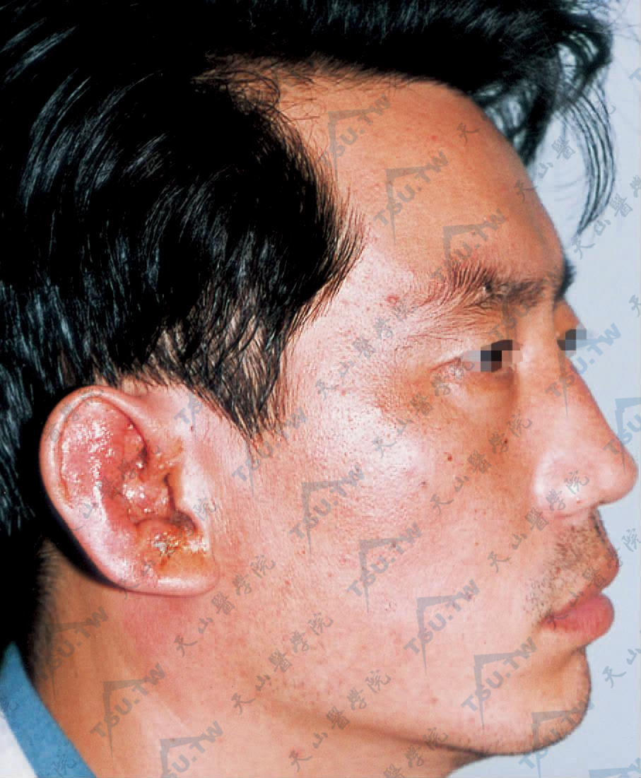 拉姆齐-亨特综合征　右外耳道、右耳廓及耳后簇集性水疱，少量渗液