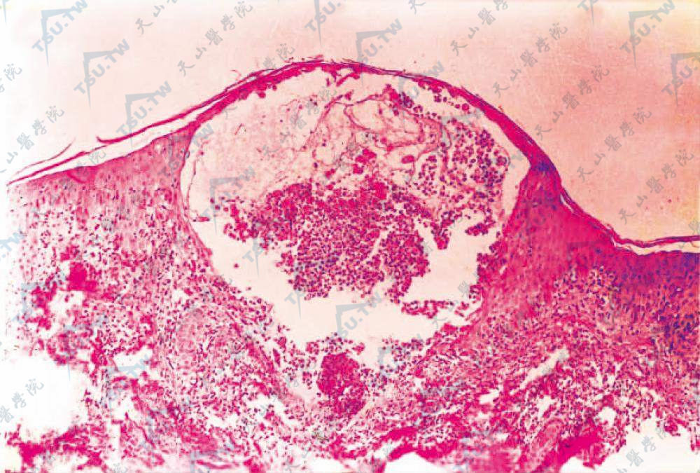 表皮内水疱，减底崩解（HE染色×100）