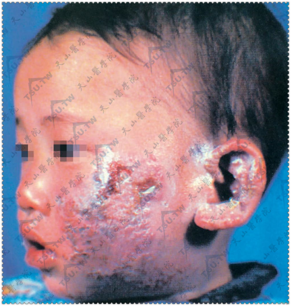 在湿疹上突发密集小。水疱，脓疱，基底明显红肿，部分疱顶有脐凹，部分皮疹干燥结痂