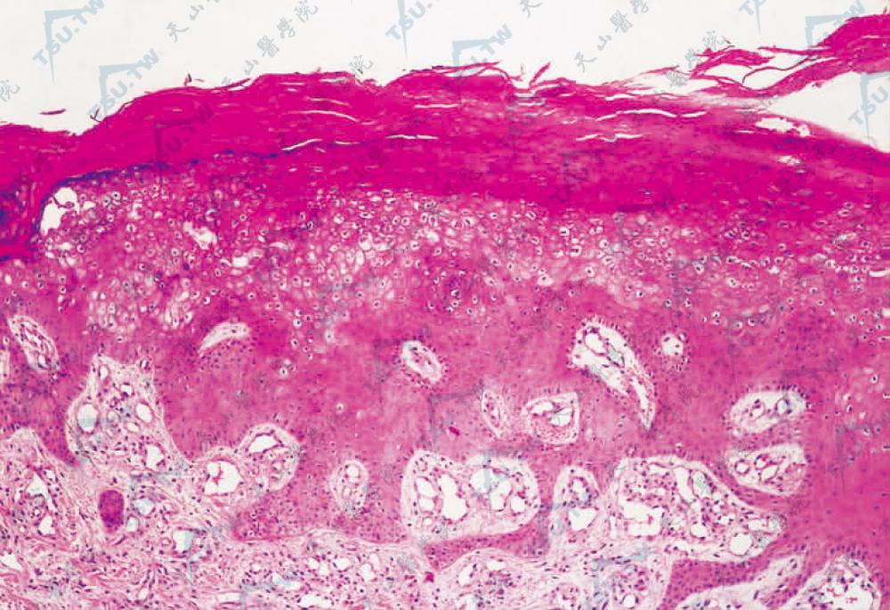 表皮角化过度伴角化不全，棘层肥厚，棘突下延，在棘层上方可见多数空泡细胞，真皮浅层毛细血管扩张，周围少数淋巴细胞浸润（HE染色×100）