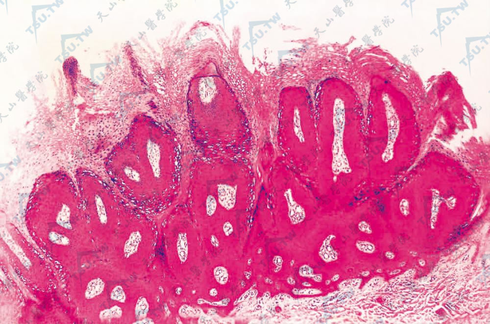 寻常疣　角化过度，棘层肥厚，乳头瘤样增生，疣体边缘表皮突向内弯曲（HE染色×100）