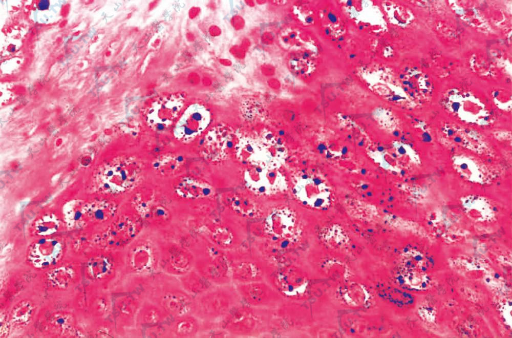 寻常疣　示棘层上部，颗粒层内见群集大空泡化细胞（HE染色×400）